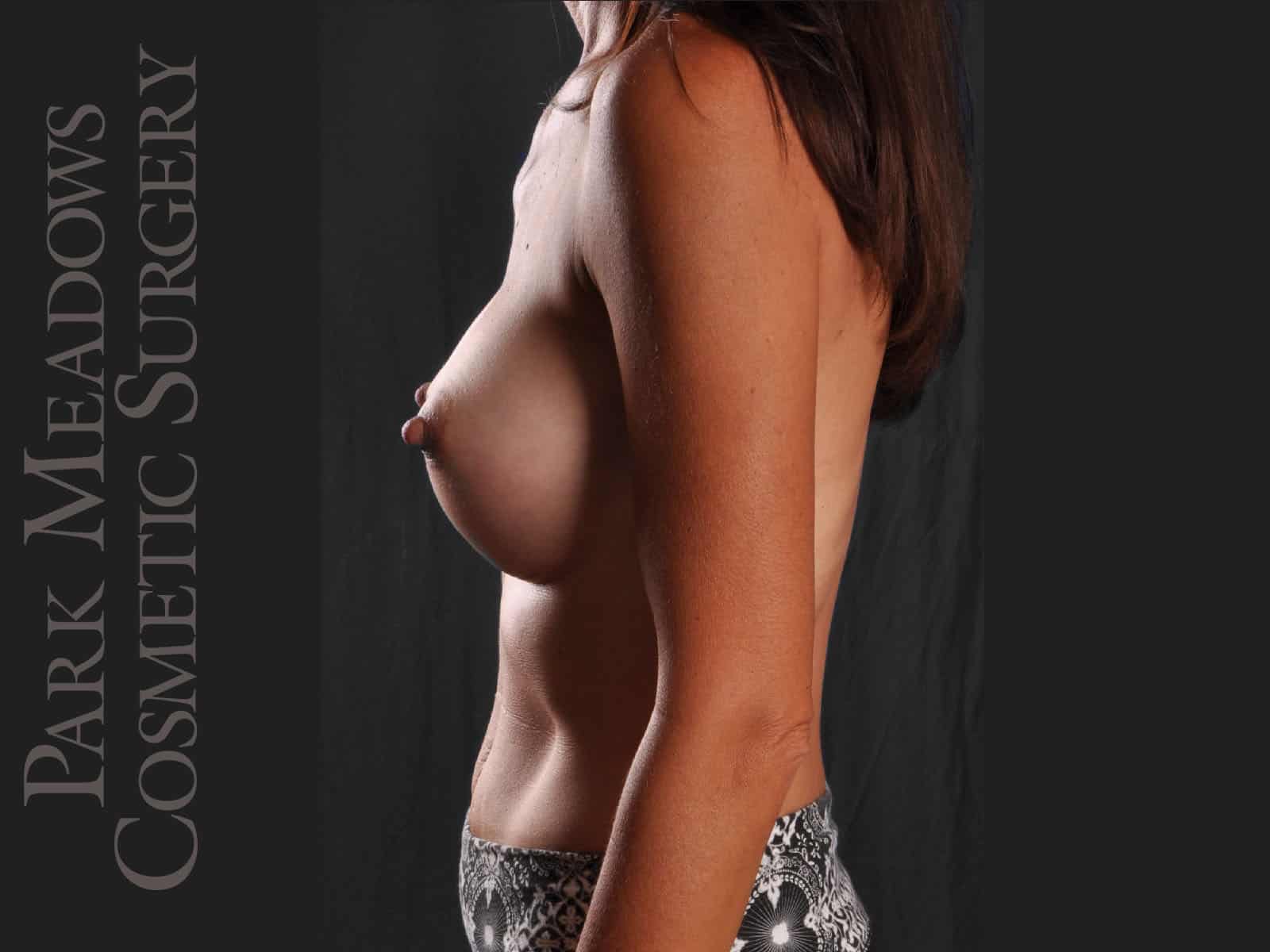 After Image: Silicone Breast Augmentation - left-side