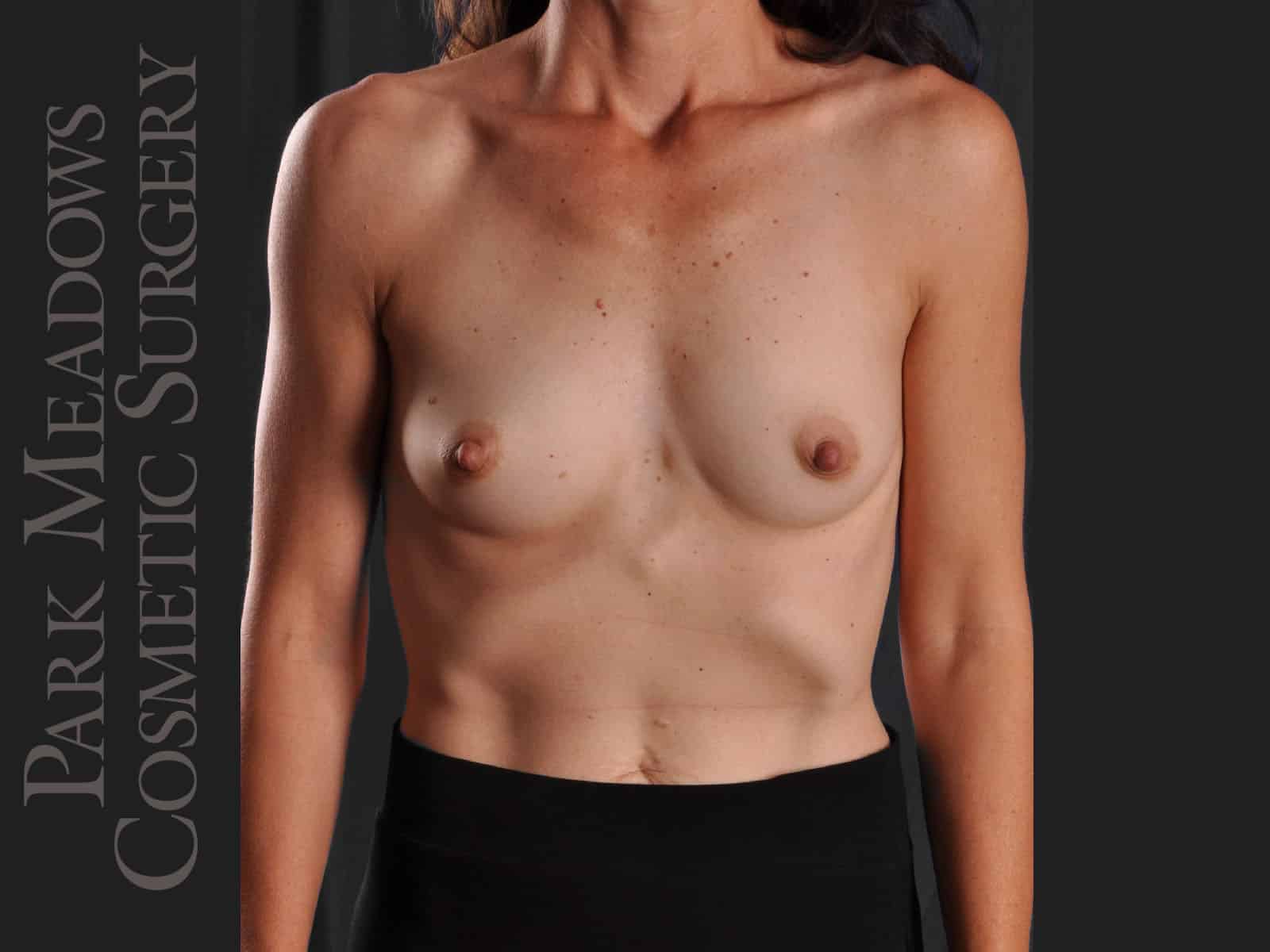 Before Image: Silicone Breast Augmentation - front