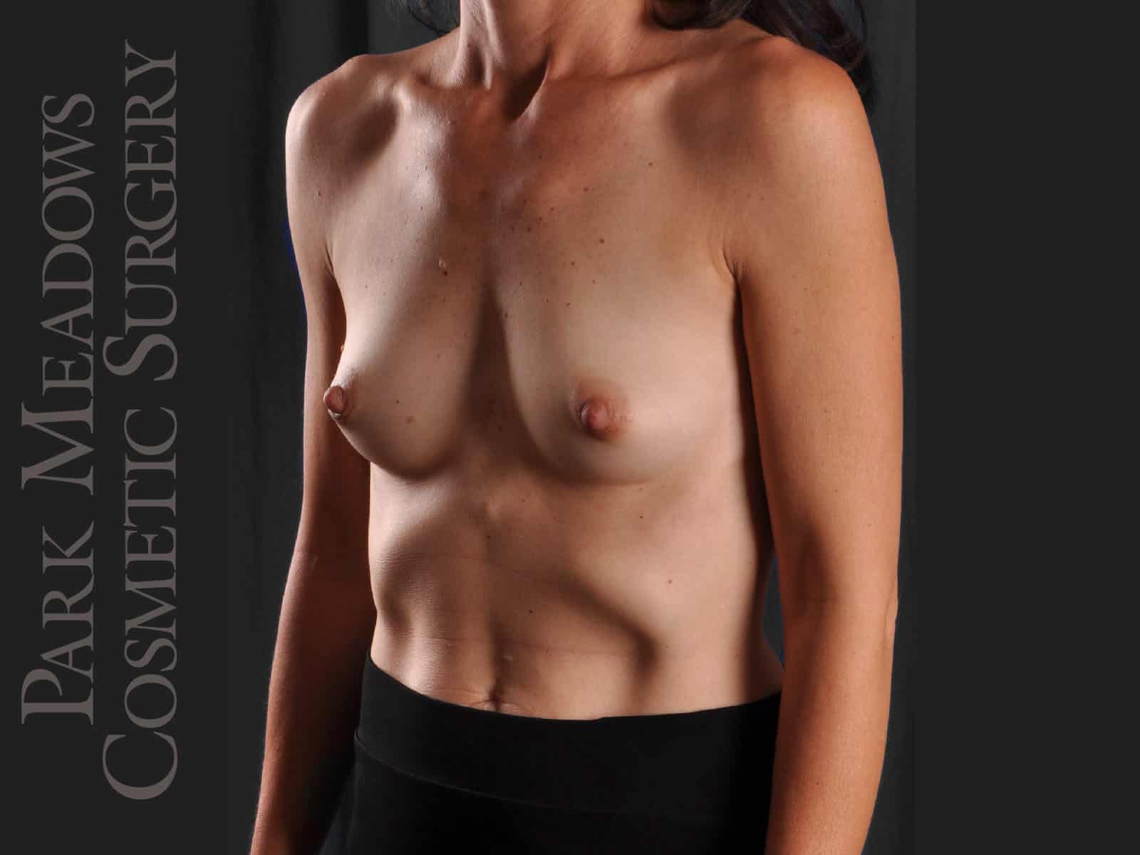 Before Image: Silicone Breast Augmentation - left-front-oblique