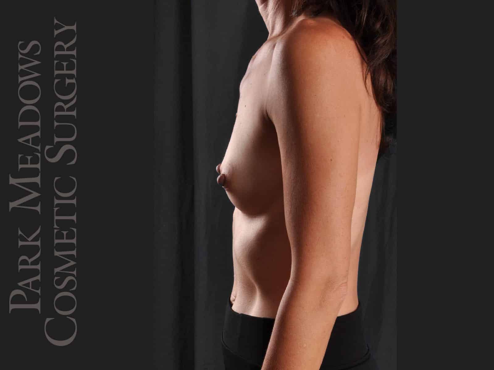 Before Image: Silicone Breast Augmentation - left-side