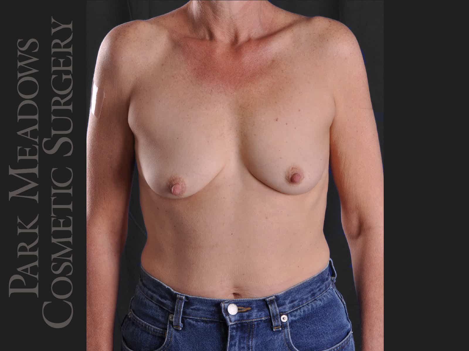 Before Image: Silicone Breast Augmentation - front