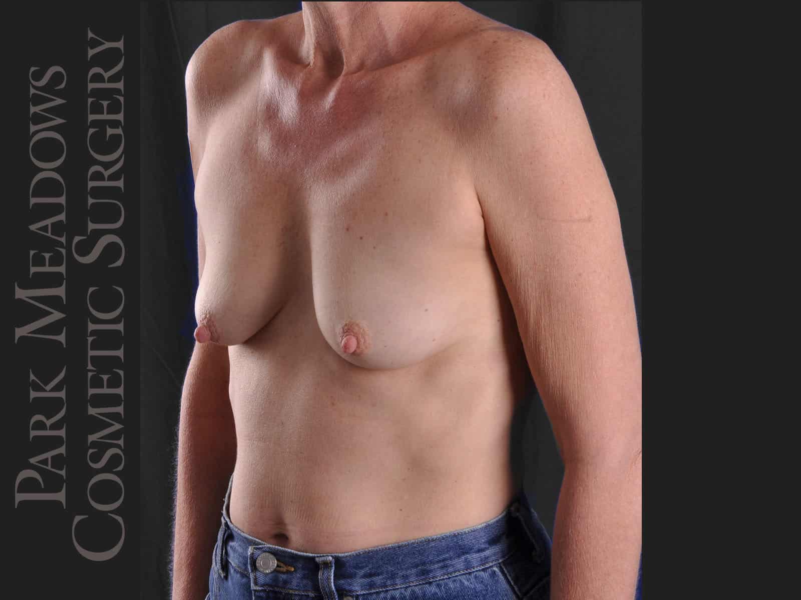 Before Image: Silicone Breast Augmentation - left-front-oblique