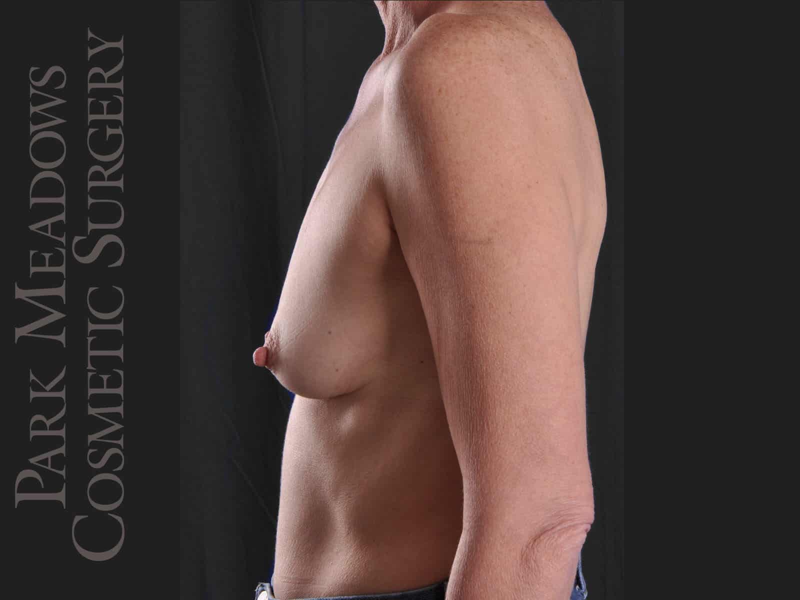 Before Image: Silicone Breast Augmentation - left-side