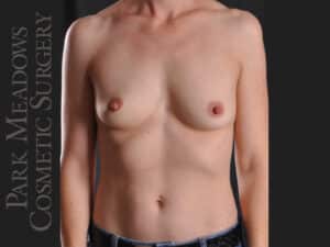 Silicone Breast Augmentation