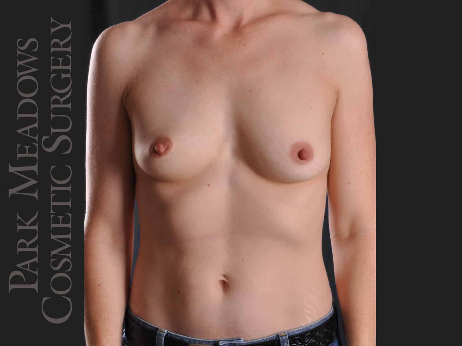 Before Image: Silicone Breast Augmentation - front