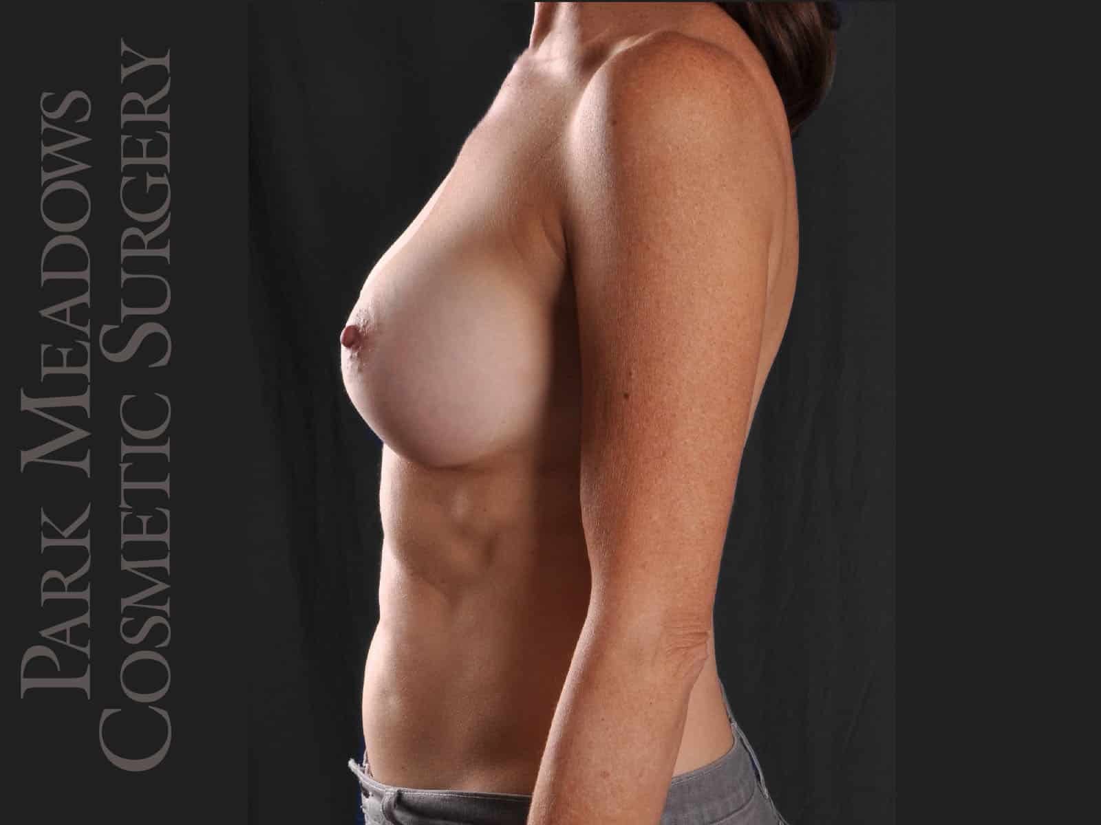 After Image: Silicone Breast Augmentation - left-side