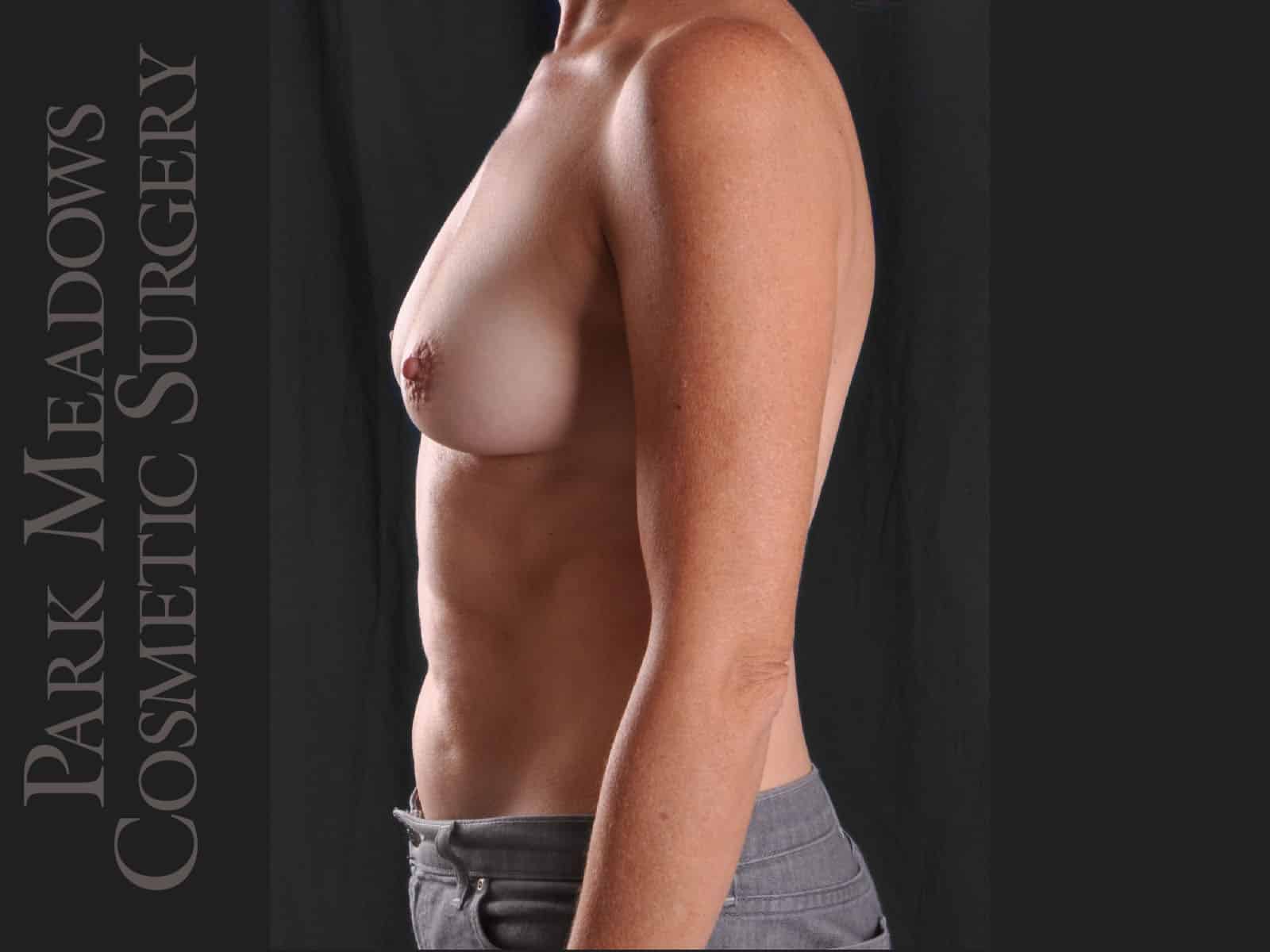 Before Image: Silicone Breast Augmentation - left-side