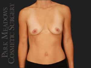 Silicone Breast Augmentation