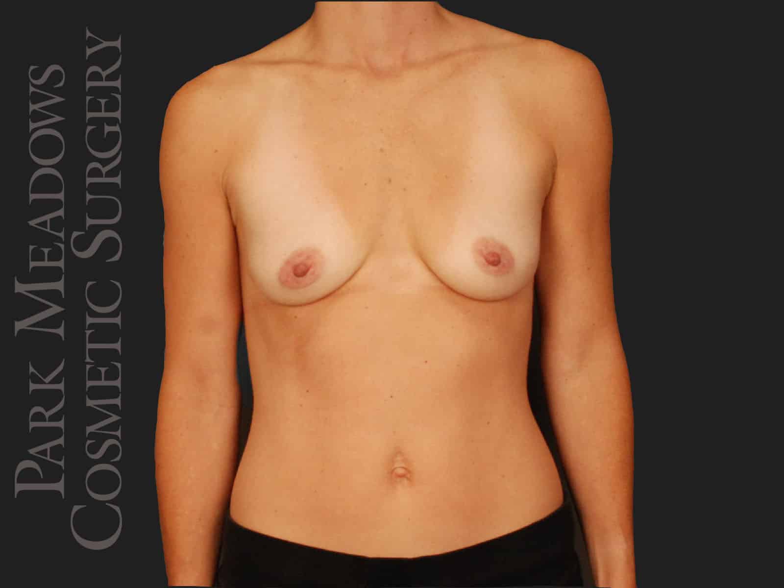 Before Image: Silicone Breast Augmentation - front