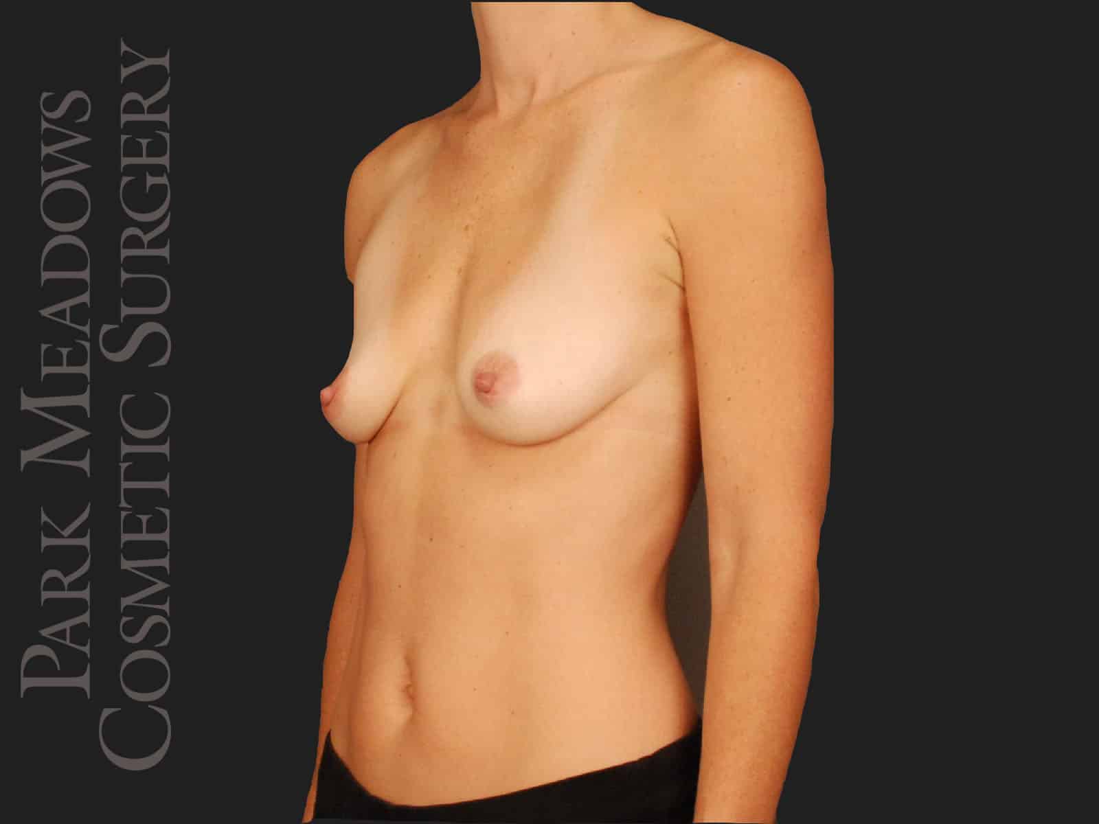 Before Image: Silicone Breast Augmentation - left-front-oblique
