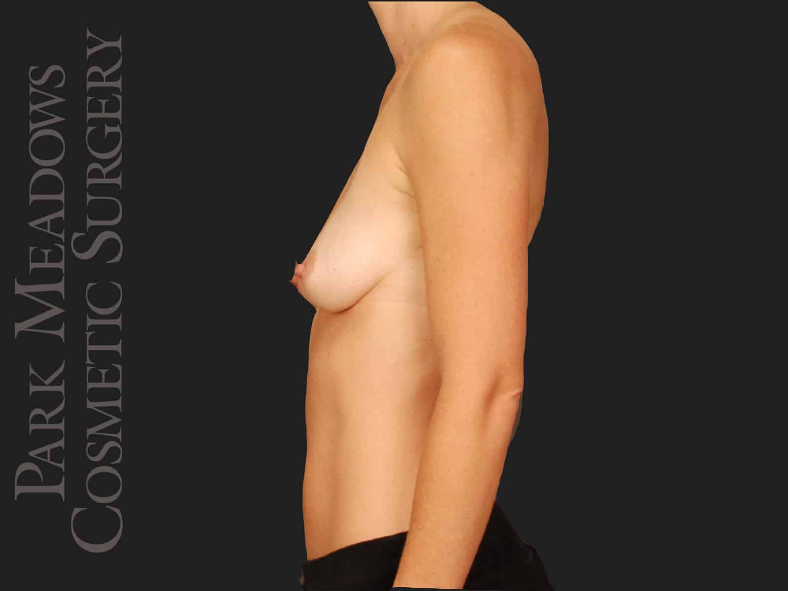 Before Image: Silicone Breast Augmentation - left-side