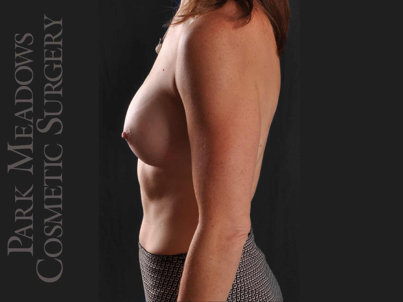 After Image: Silicone Breast Augmentation - left-side