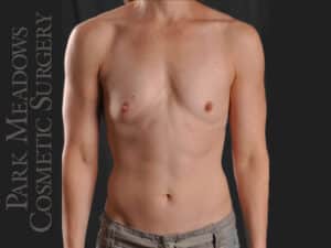 Silicone Breast Augmentation