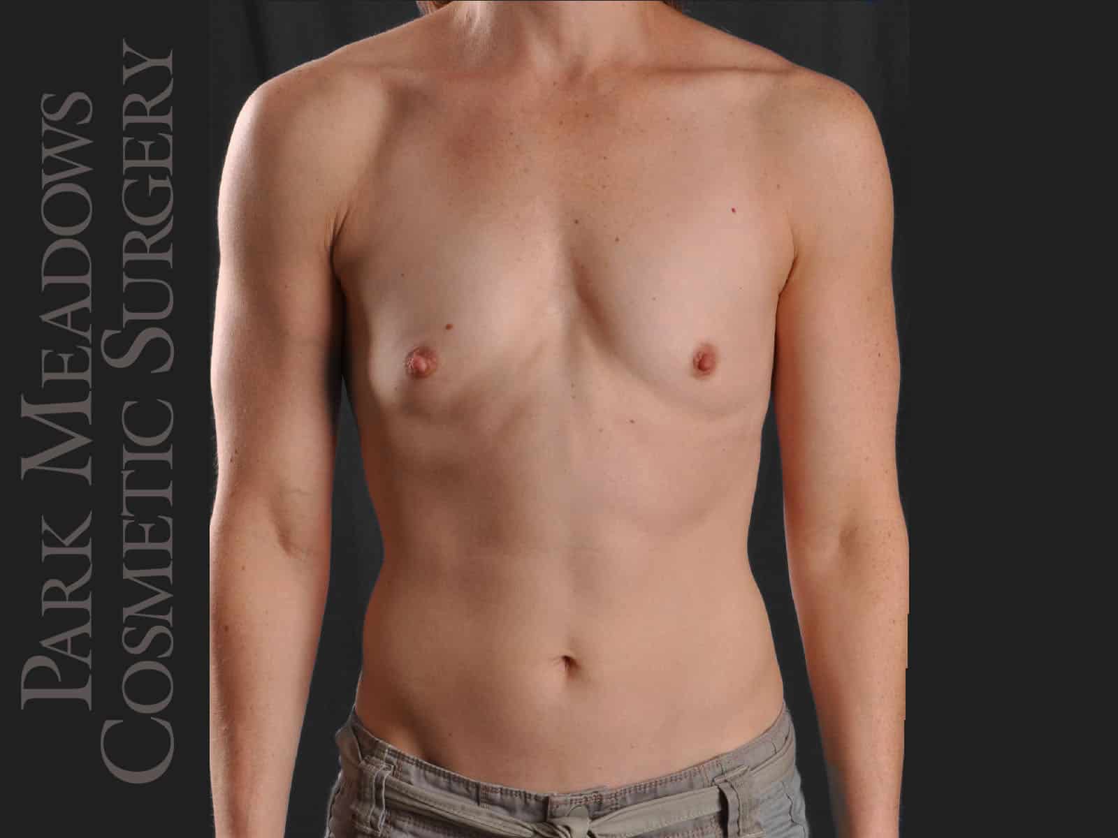 Before Image: Silicone Breast Augmentation - front