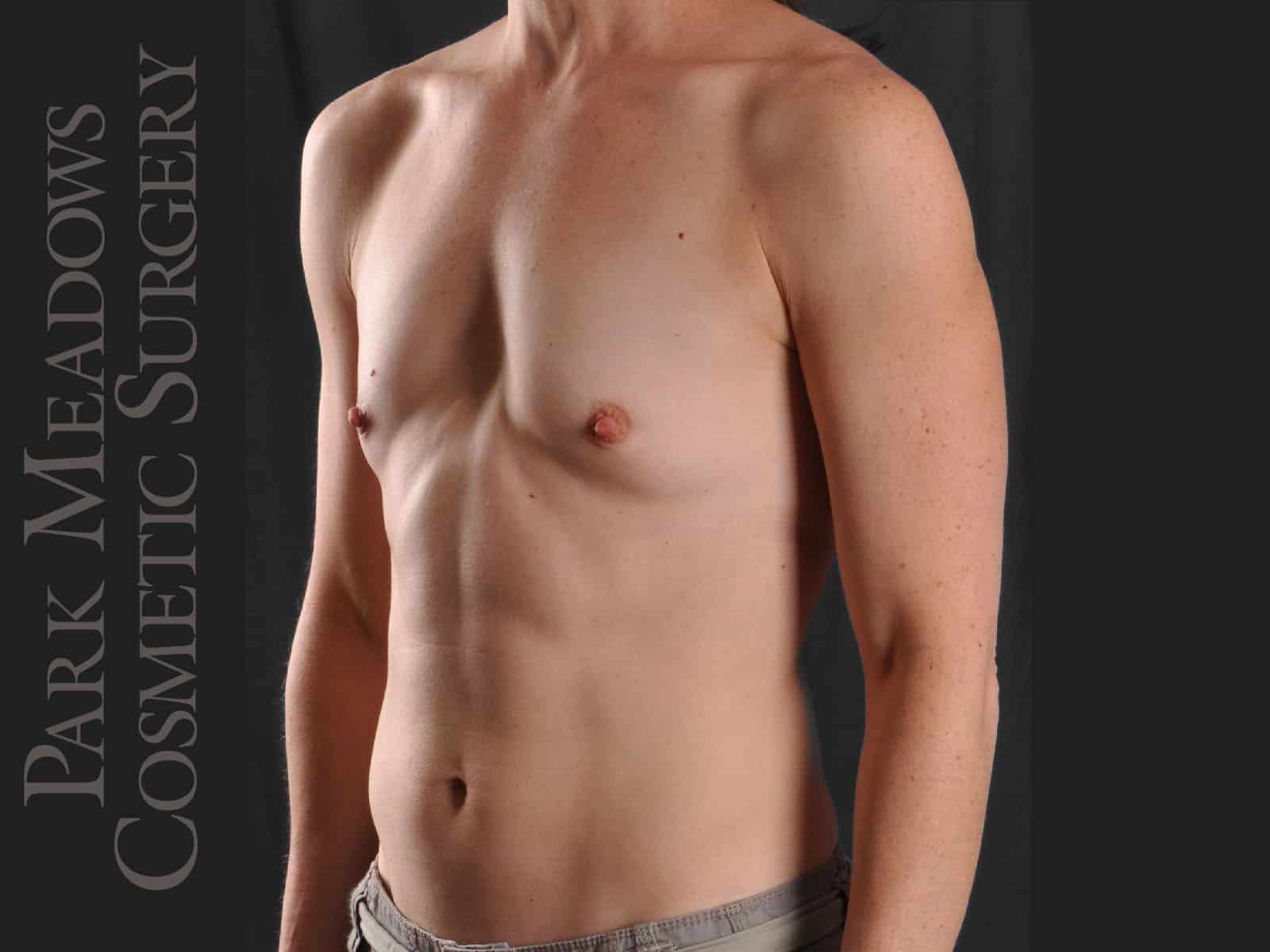 Before Image: Silicone Breast Augmentation - left-front-oblique