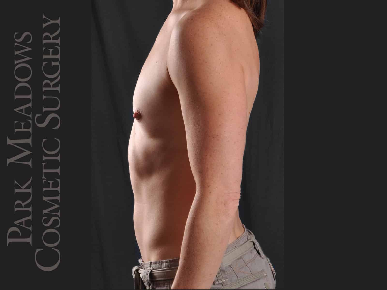Before Image: Silicone Breast Augmentation - left-side