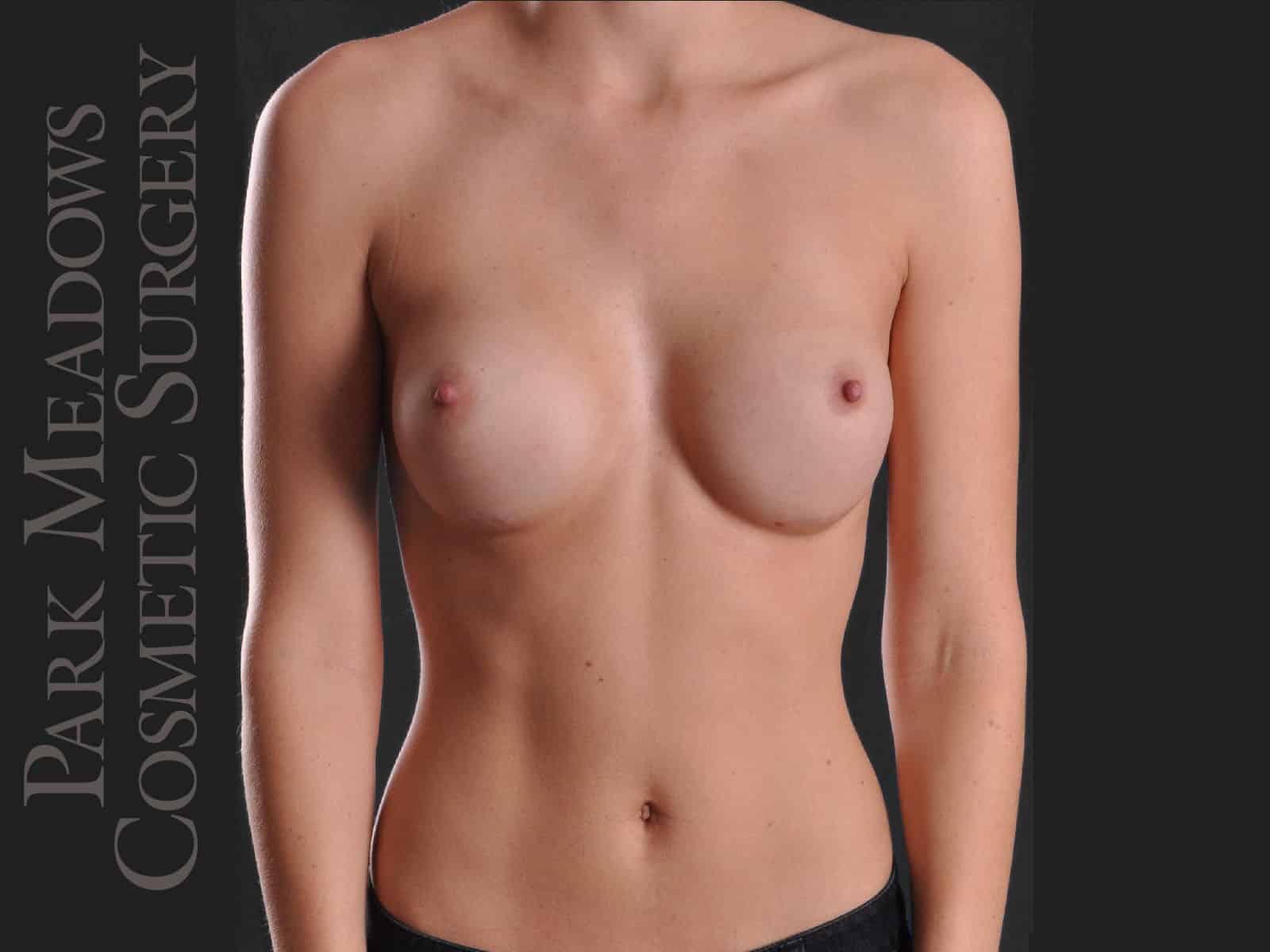 After Image: Silicone Breast Augmentation - front
