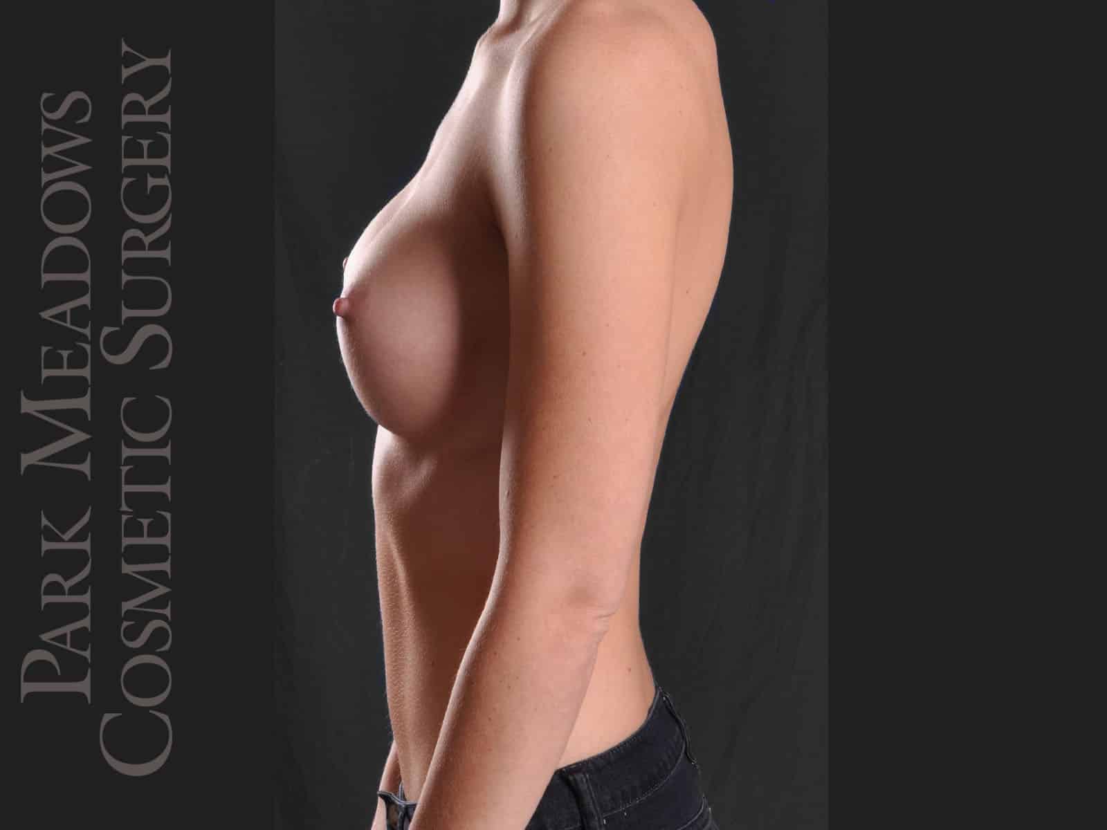 After Image: Silicone Breast Augmentation - left-side