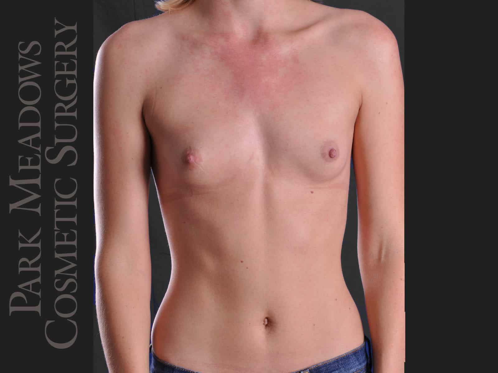 Before Image: Silicone Breast Augmentation - front