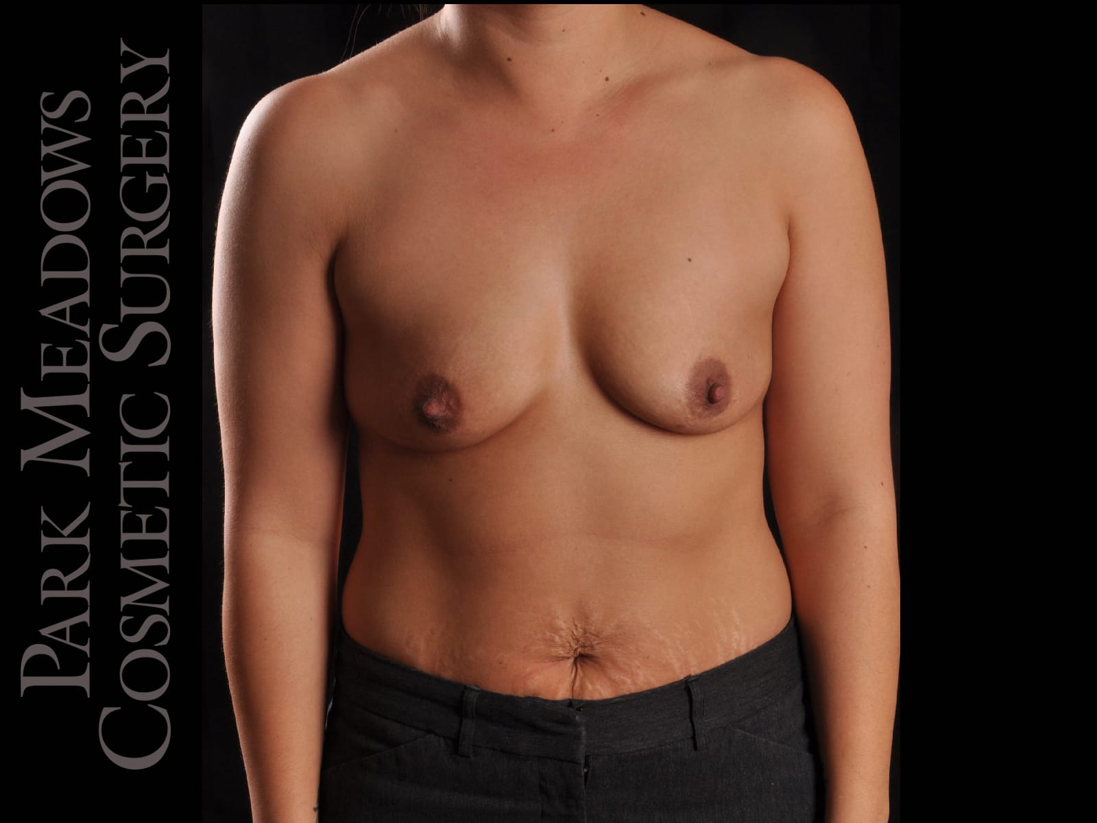 Before Image: Silicone Breast Augmentation - front