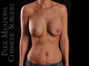 Silicone Breast Augmentation