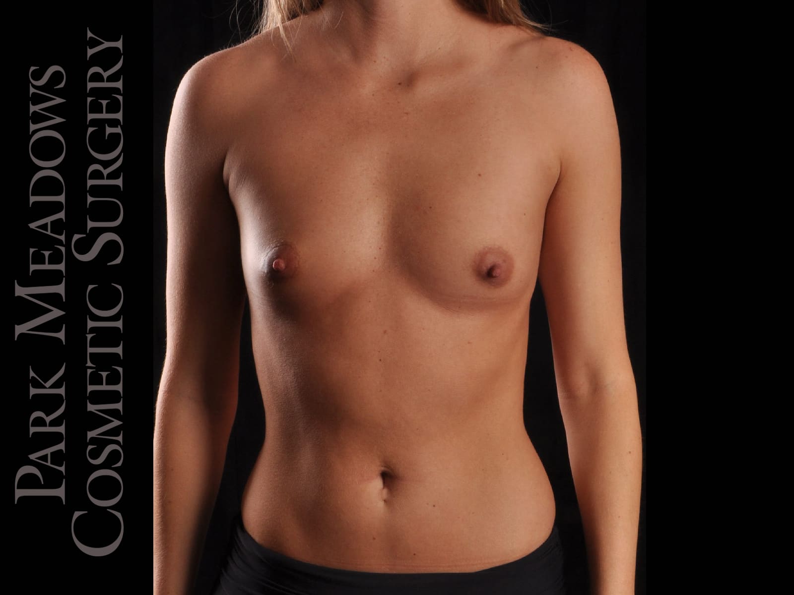 Before Image: Silicone Breast Augmentation - front