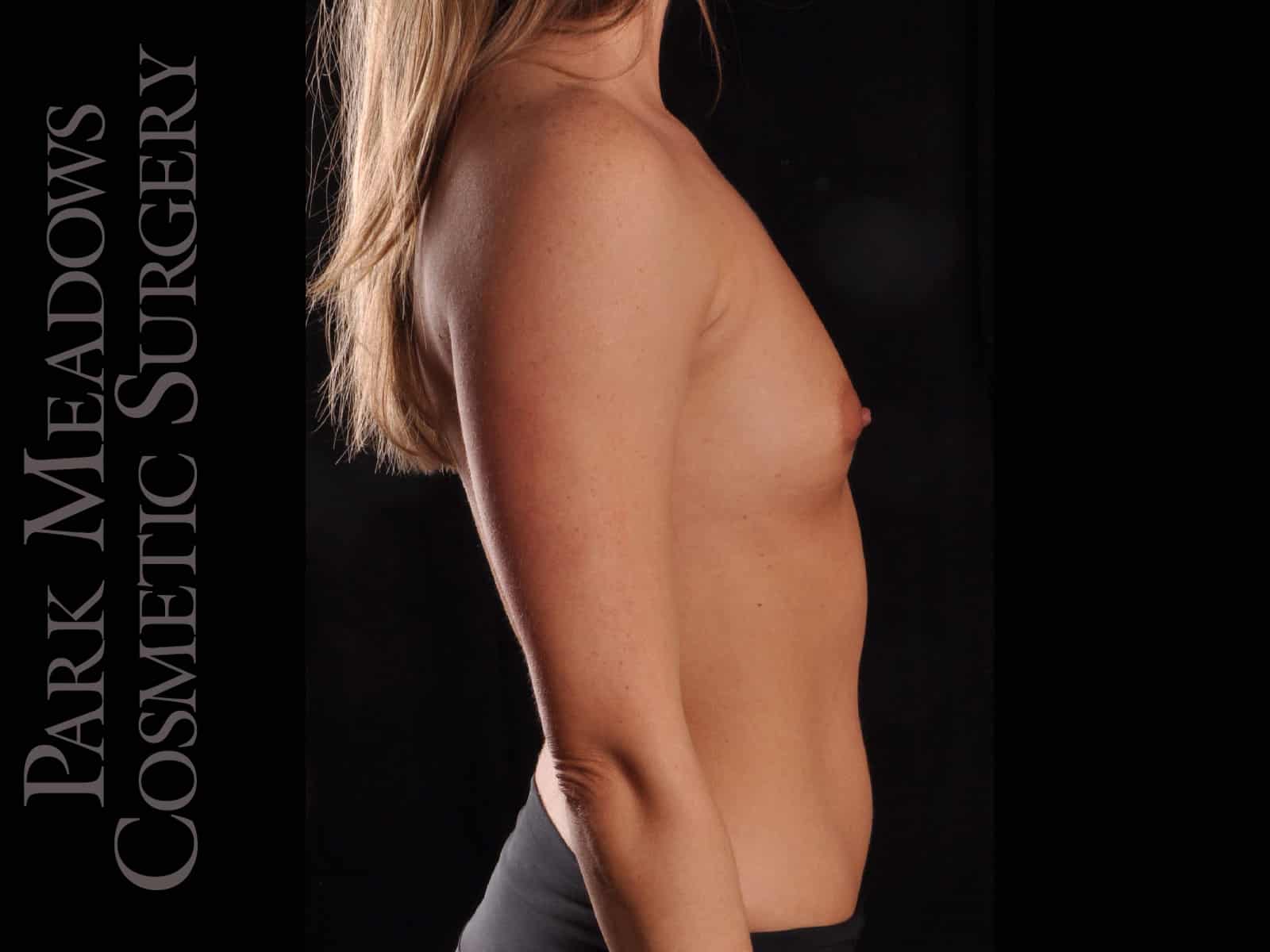 Before Image: Silicone Breast Augmentation -
