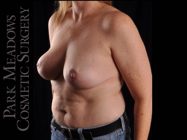 After Image: Cosmetic Breast Reduction -