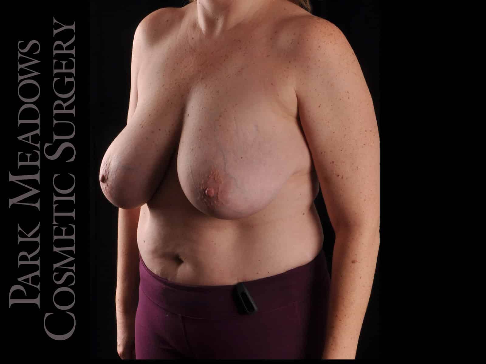Before Image: Cosmetic Breast Reduction -