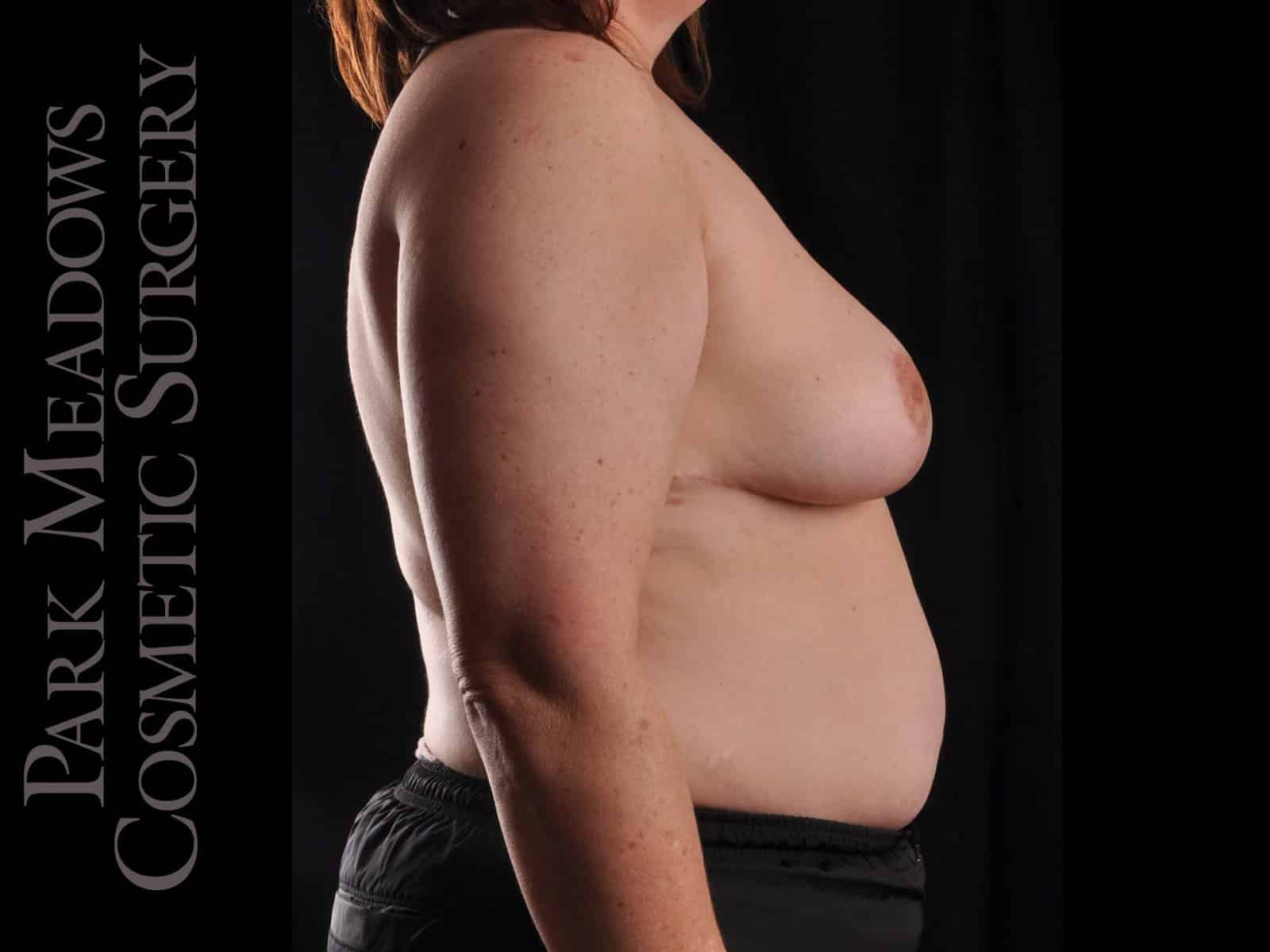 After Image: Cosmetic Breast Reduction - right-side