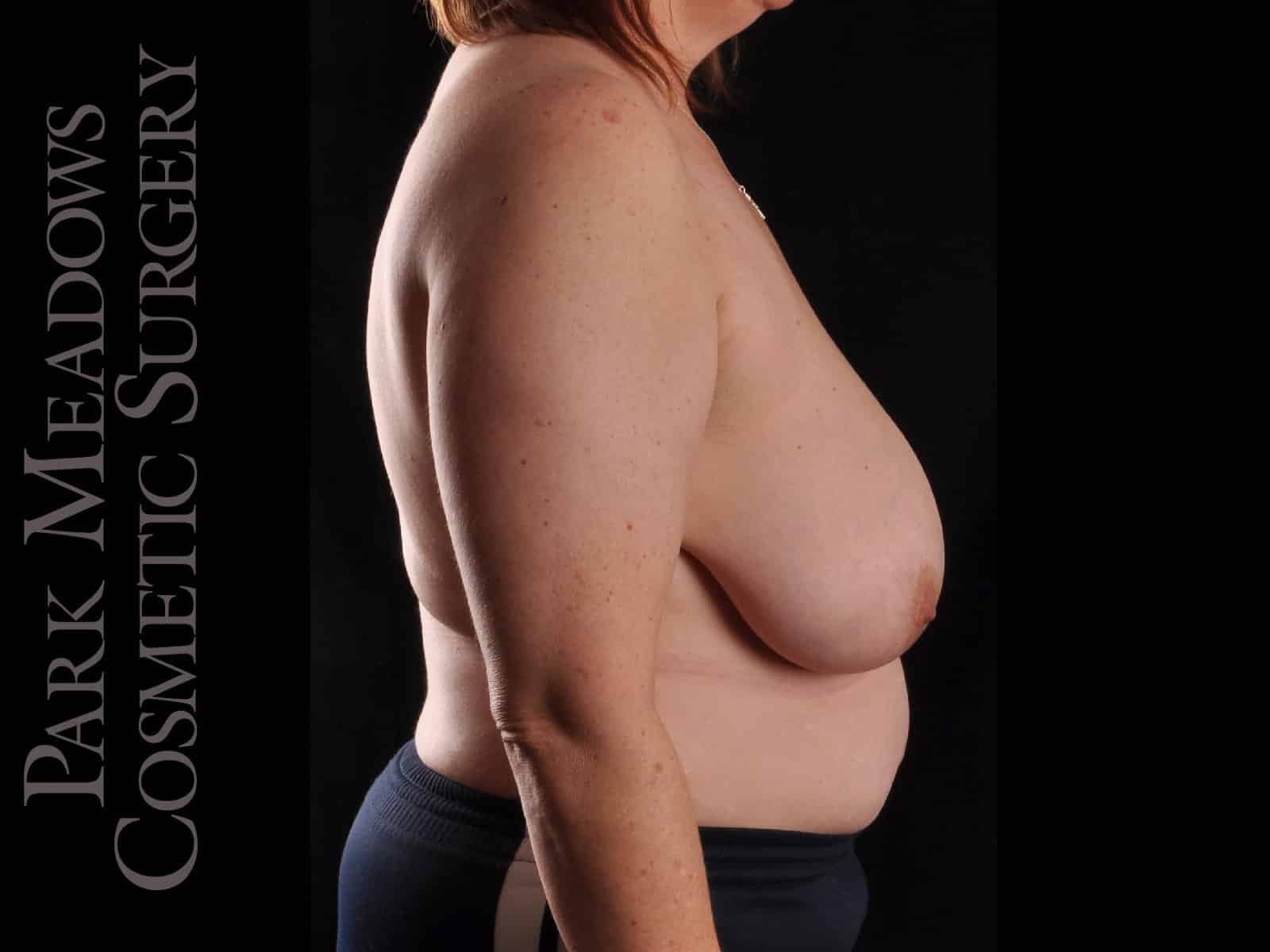 Before Image: Cosmetic Breast Reduction - right-side