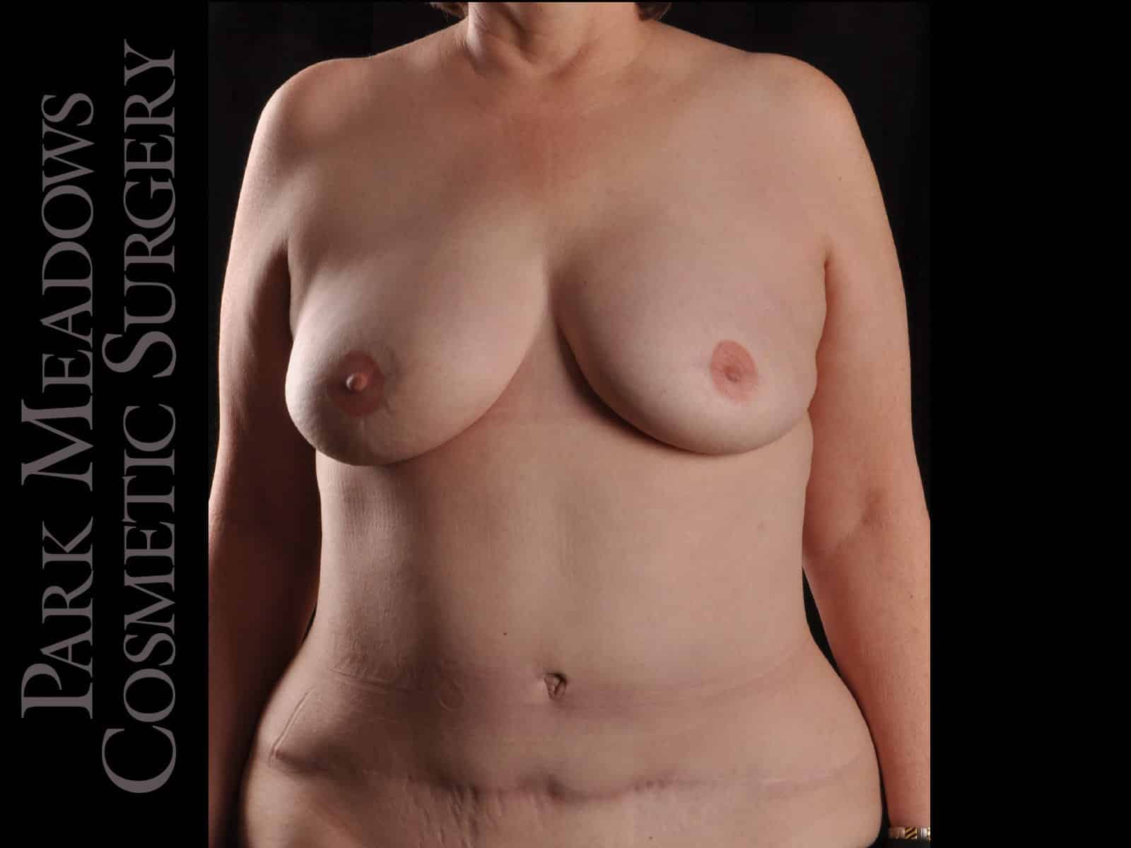 After Image: Bilateral DIEP Flap; two separate fat grafting sessions; nipple reconstruction and areola pigmentation - front