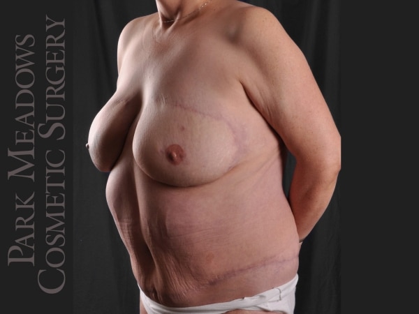 After Image: Painful, failed implant, removed by another surgeon; removal of other implant, bilateral DIEP Flap, fat grafting, nipple reconstruction and areola pigmentation - left-front-oblique