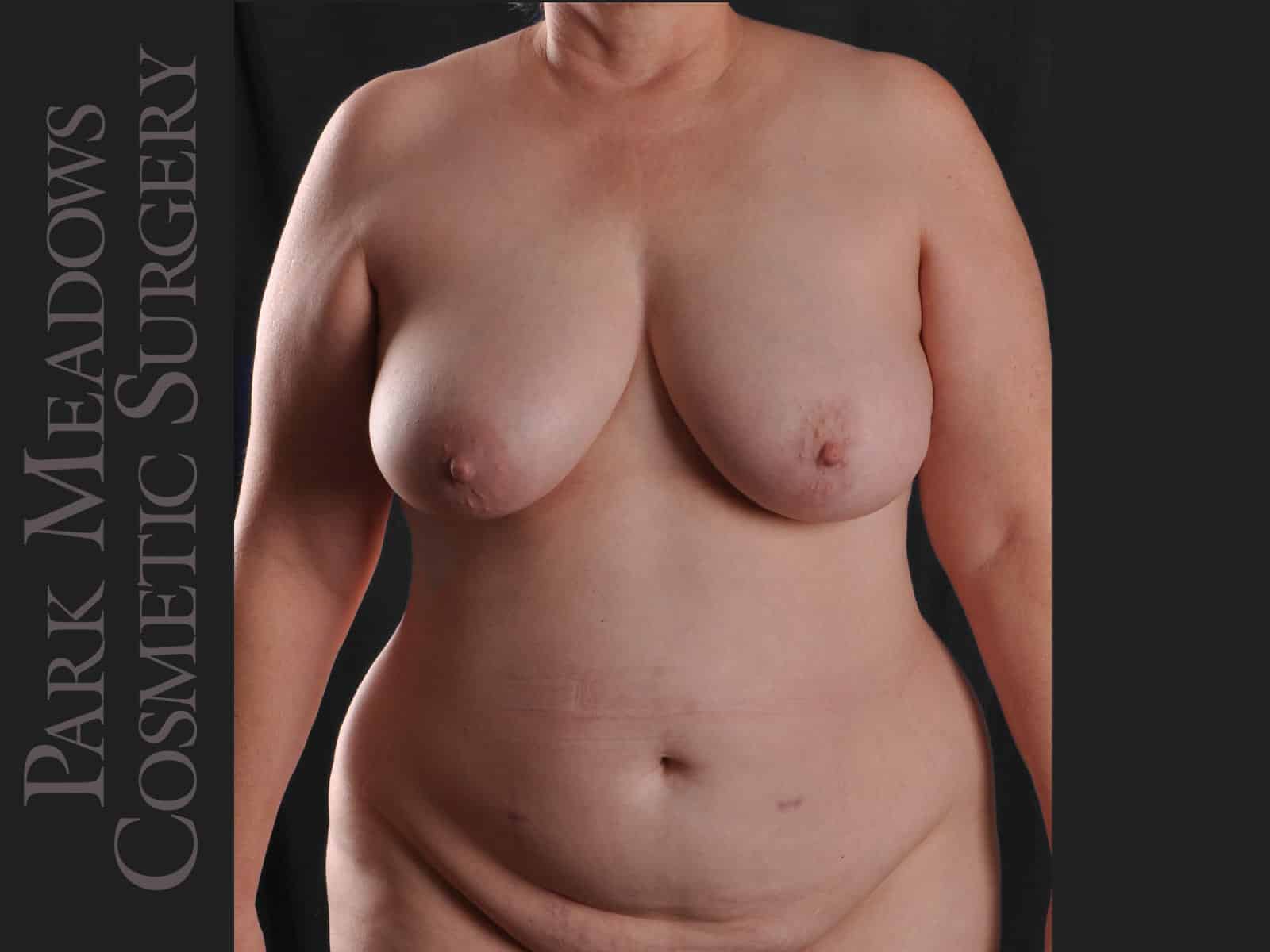 Before Image: Bilateral DIEP Flap; two separate fat grafting sessions; nipple reconstruction and areola pigmentation - front