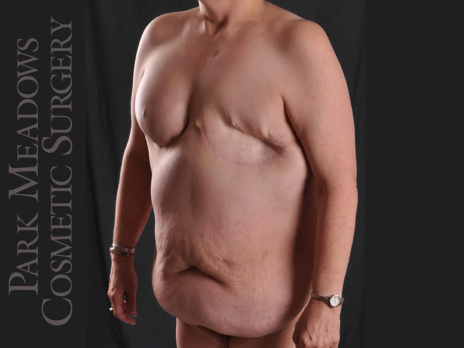 Before Image: Painful, failed implant, removed by another surgeon; removal of other implant, bilateral DIEP Flap, fat grafting, nipple reconstruction and areola pigmentation - left-front-oblique