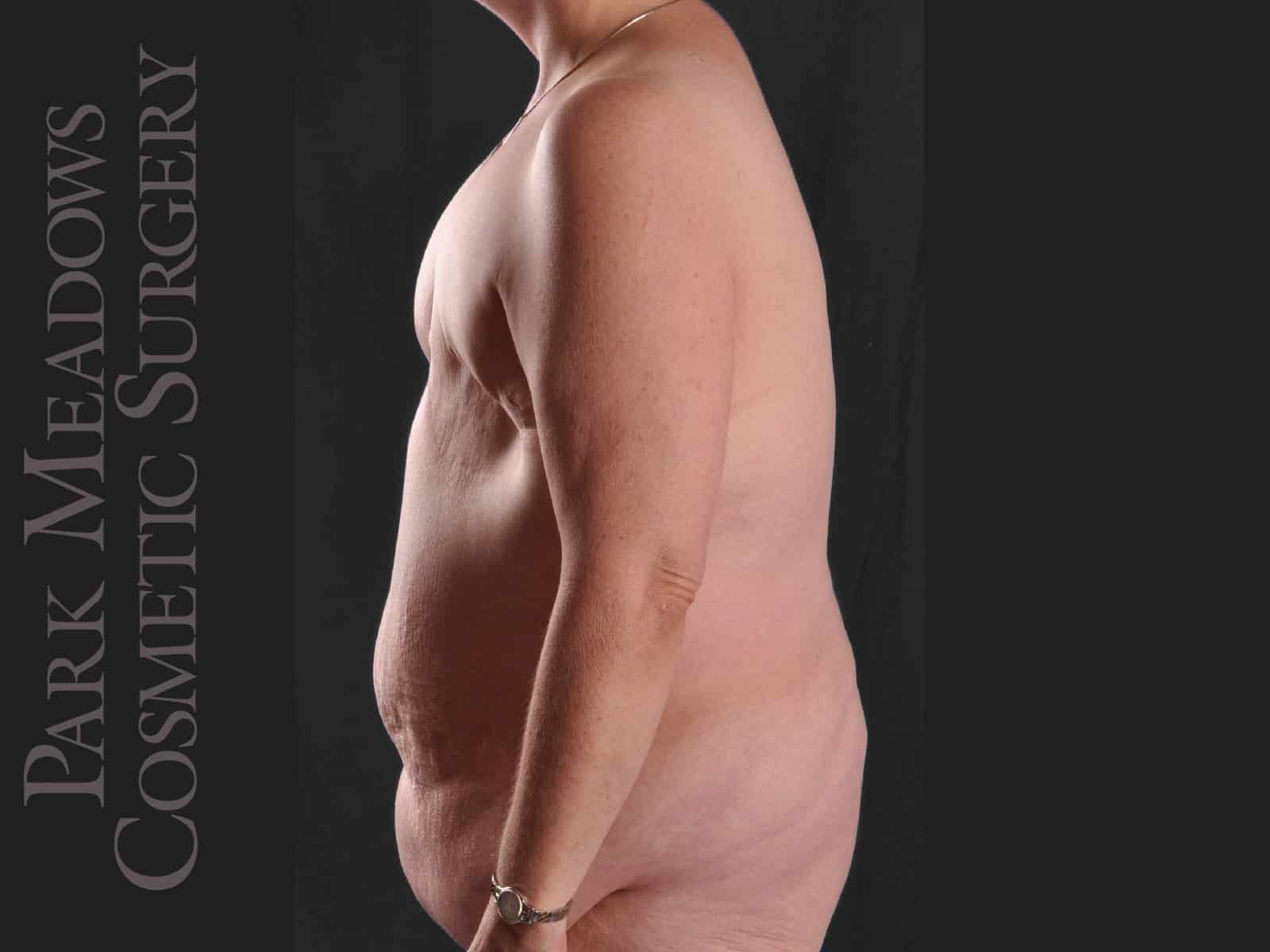 Before Image: Painful, failed implant, removed by another surgeon; removal of other implant, bilateral DIEP Flap, fat grafting, nipple reconstruction and areola pigmentation - left-side