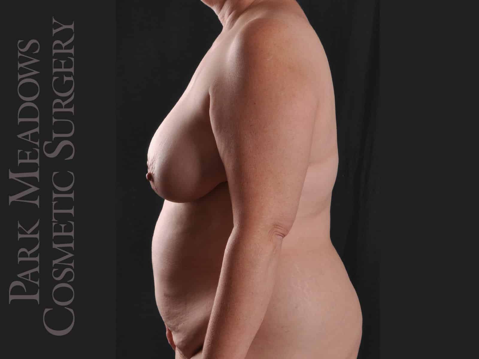 Before Image: Bilateral DIEP Flap; two separate fat grafting sessions; nipple reconstruction and areola pigmentation - left-side