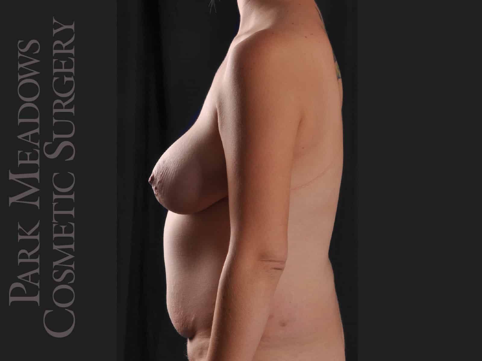 Before Image: Bilateral DIEP Flap, three separate fat grafting sessions, nipple reconstruction, areola pigmentation pigmentation - left-side