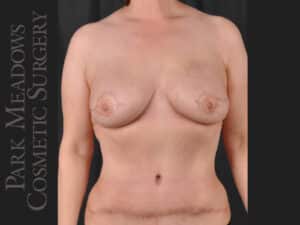 Procedure: Bilateral DIEP Flap; two separate fat grafting sessions; nipple reconstruction and areola pigmentation
