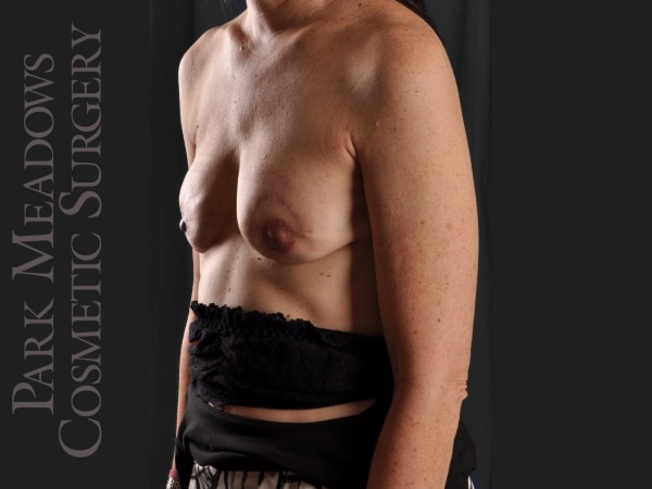 After Image: Bilateral DIEP Flap; two separate fat grafting sessions; nipple reconstruction and areola pigmentation - left-front-oblique