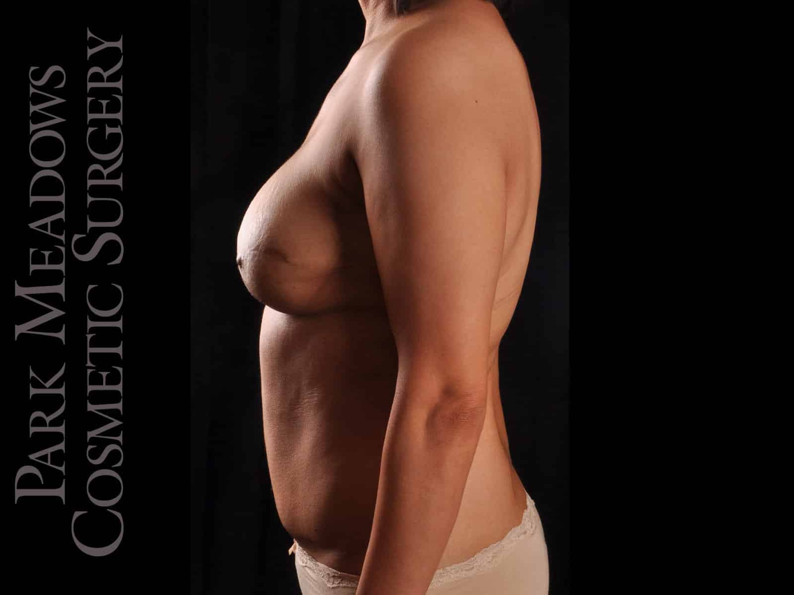 After Image: Bilateral DIEP Flap; three separate fat grafting sessions; nipple reconstruction and areola pigmentation - left-side