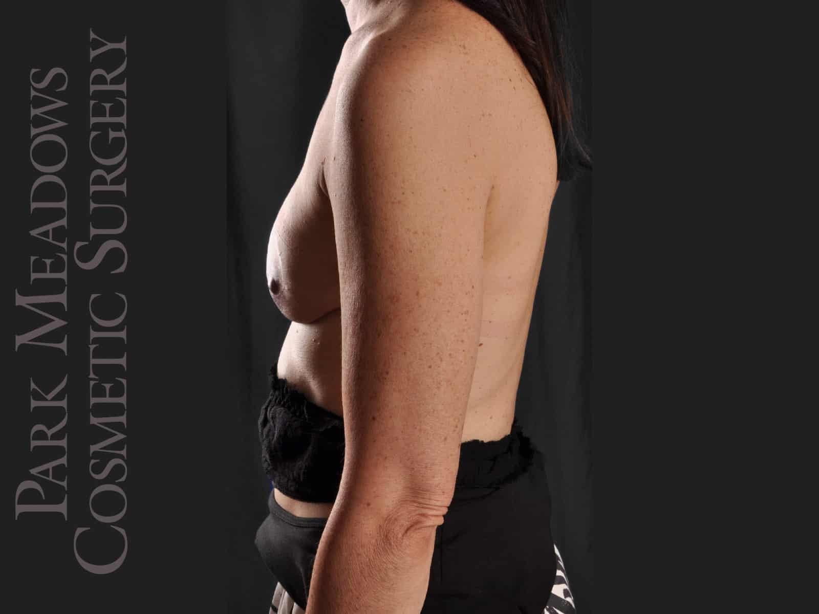 After Image: Bilateral DIEP Flap; two separate fat grafting sessions; nipple reconstruction and areola pigmentation - left-side
