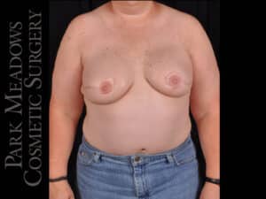 Bilateral DIEP Flap; three separate fat grafting sessions; nipple reconstruction and areola pigmentation