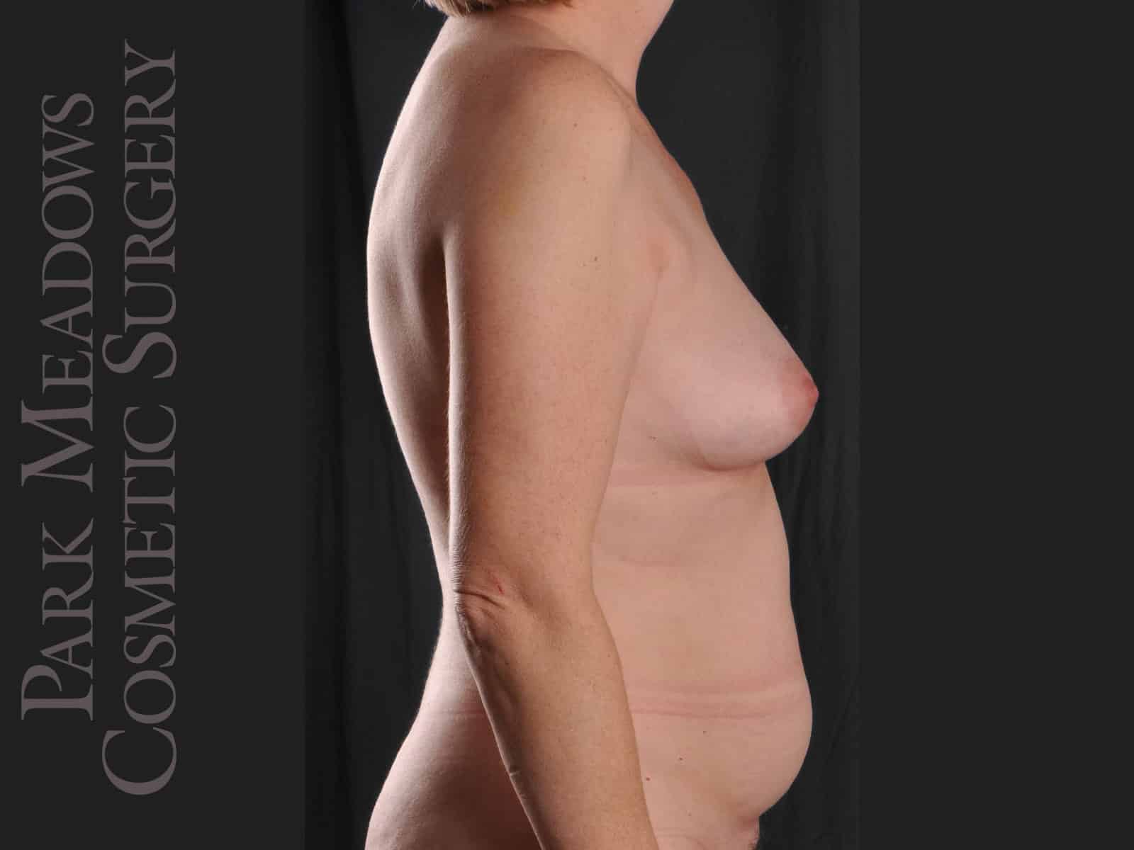 Before Image: Bilateral DIEP Flap; three separate fat grafting sessions; nipple reconstruction and areola pigmentation - right-side