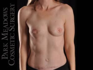 Bilateral DIEP Flap; three separate fat grafting sessions; nipple reconstruction and areola pigmentation
