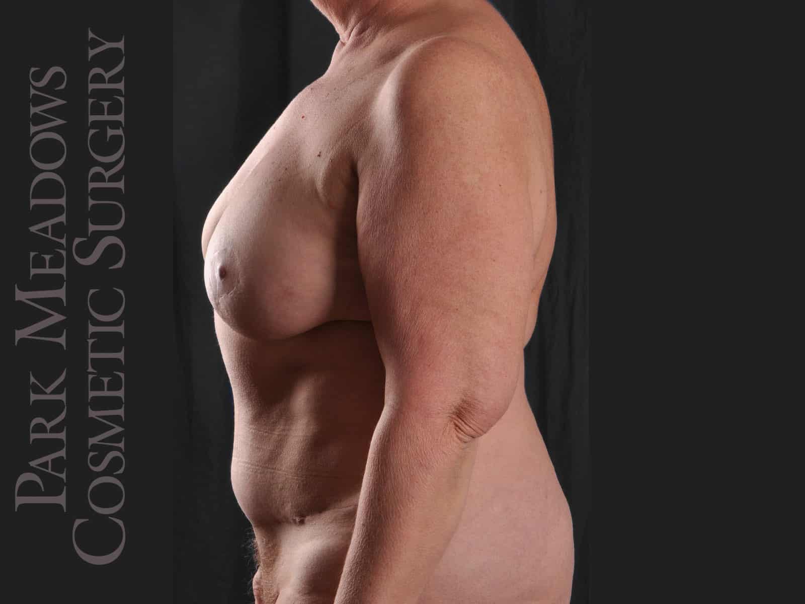 After Image: Unilateral (left) mastectomy with immediate DIEP - left-side