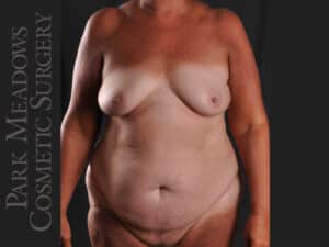 Unilateral (left) mastectomy with immediate DIEP