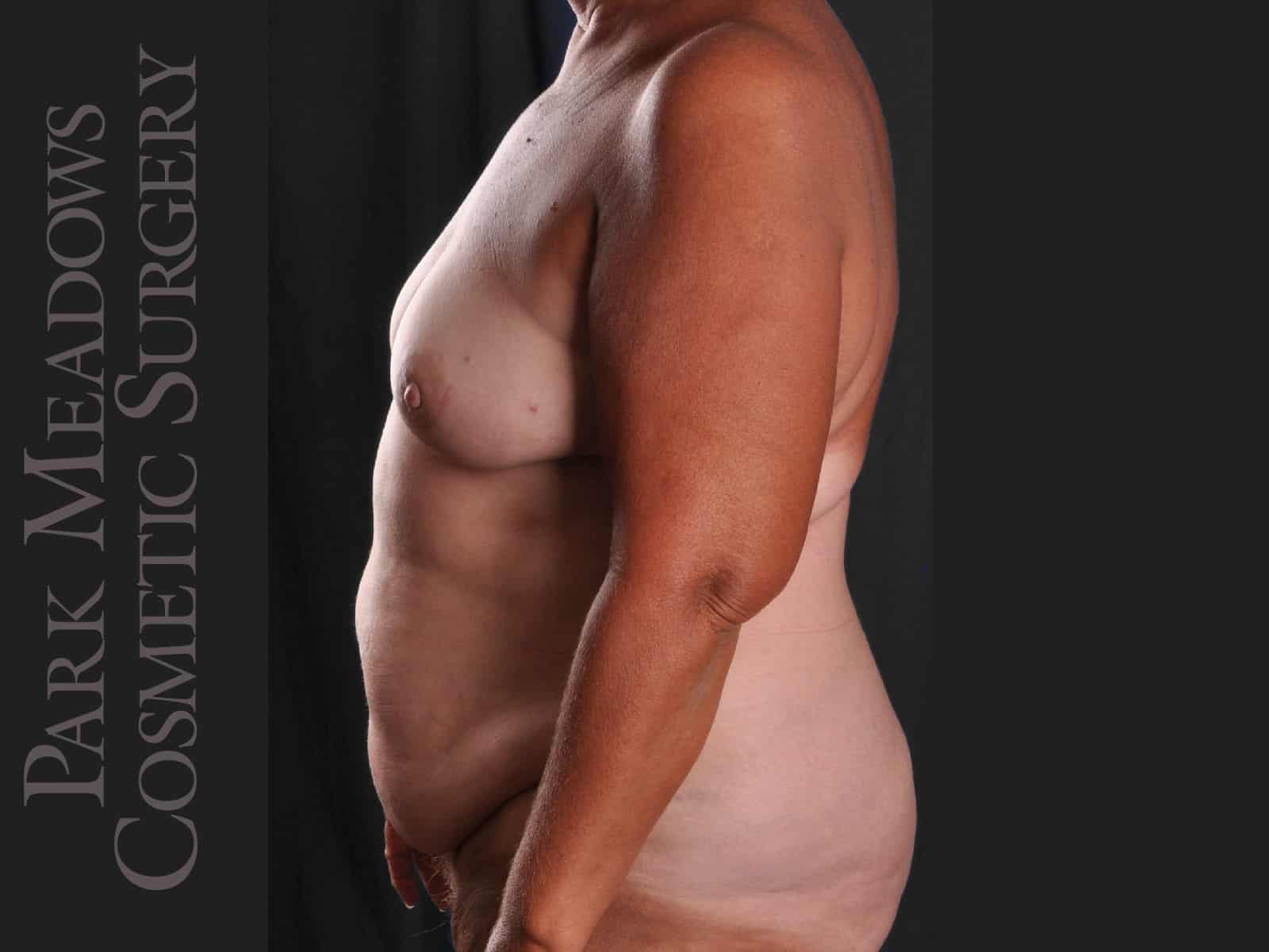 Before Image: Unilateral (left) mastectomy with immediate DIEP - left-side