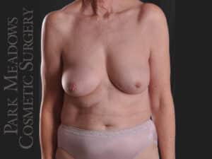 Bilateral DIEP Flap; two separate fat grafting sessions; nipple reconstruction and areola pigmentation