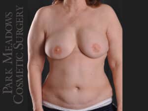 Bilateral DIEP Flap; two separate fat grafting sessions; nipple reconstruction and areola pigmentation